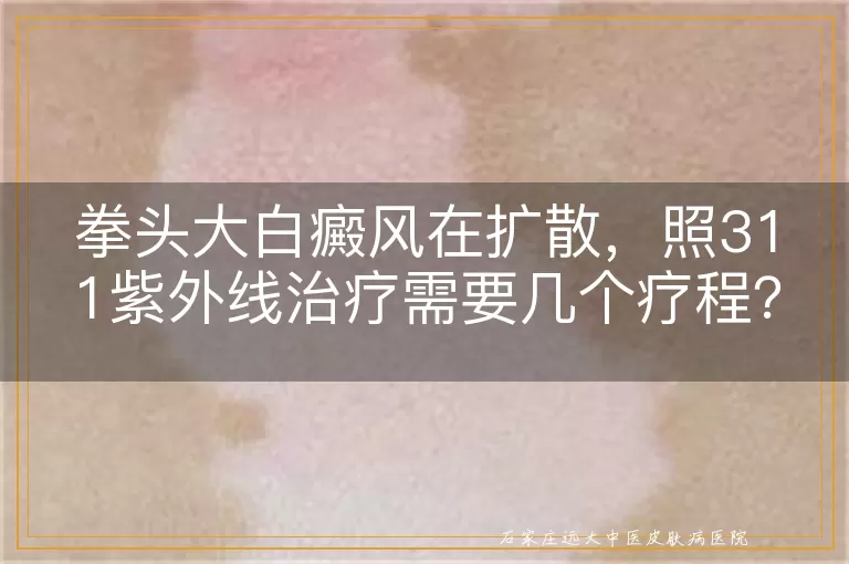 拳头大白癜风在扩散，照311紫外线治疗需要几个疗程？