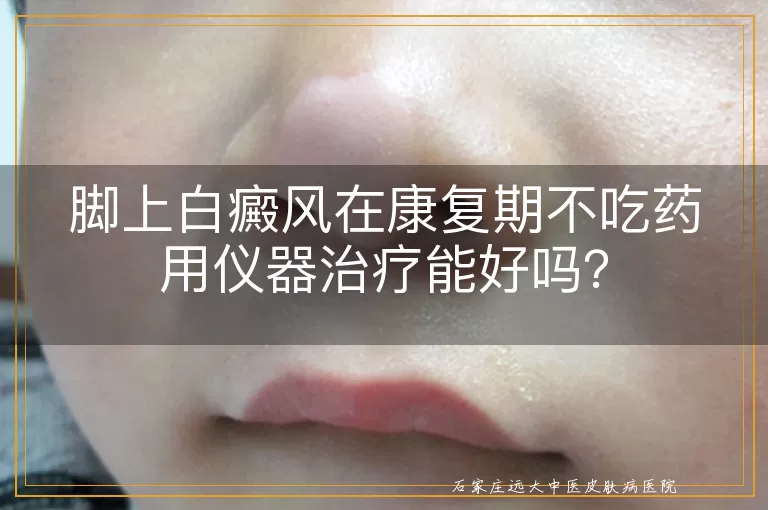 脚上白癜风在康复期不吃药用仪器治疗能好吗？