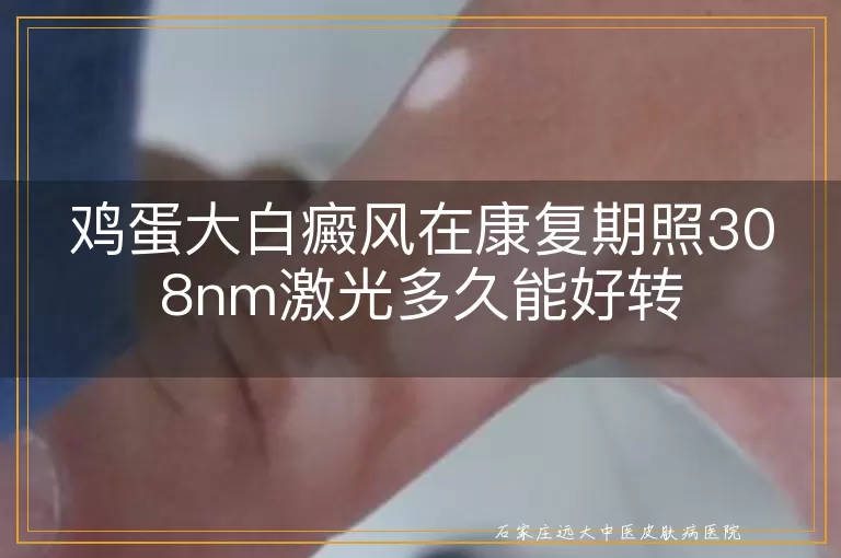 鸡蛋大白癜风在康复期照308nm激光多久能好转