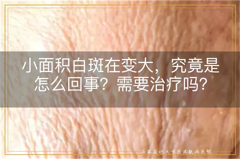小面积白斑在变大，究竟是怎么回事？需要治疗吗？