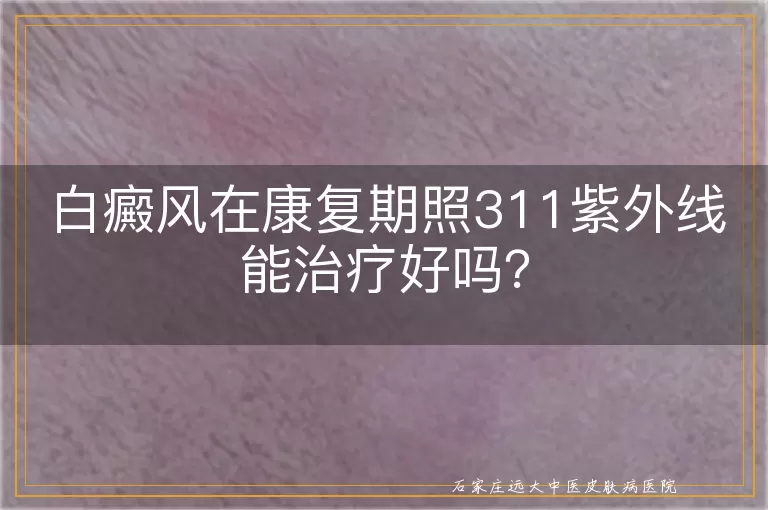 白癜风在康复期照311紫外线能治疗好吗？