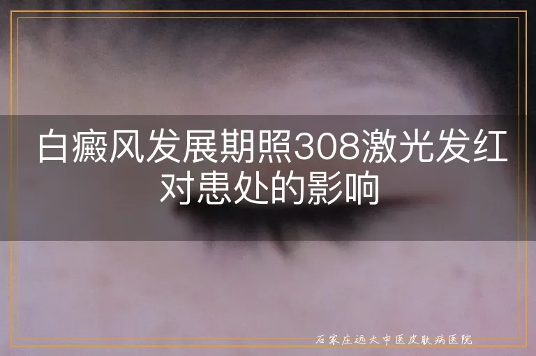 白癜风发展期照308激光发红对患处的影响