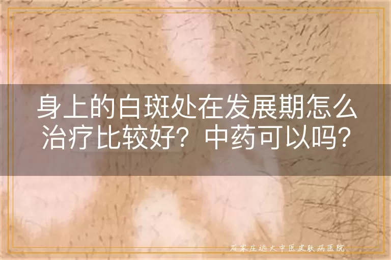 身上的白斑处在发展期怎么治疗比较好？中药可以吗？