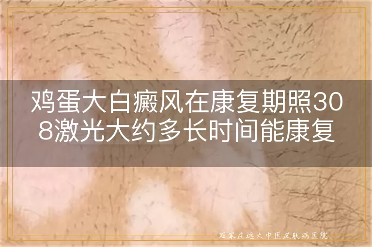 鸡蛋大白癜风在康复期照308激光大约多长时间能康复