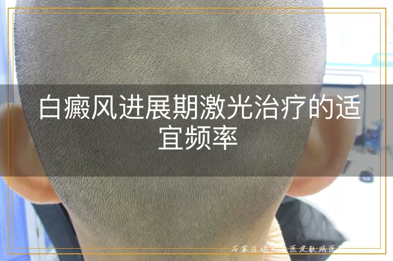 白癜风进展期激光治疗的适宜频率