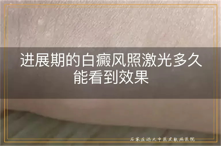 进展期的白癜风照激光多久能看到效果