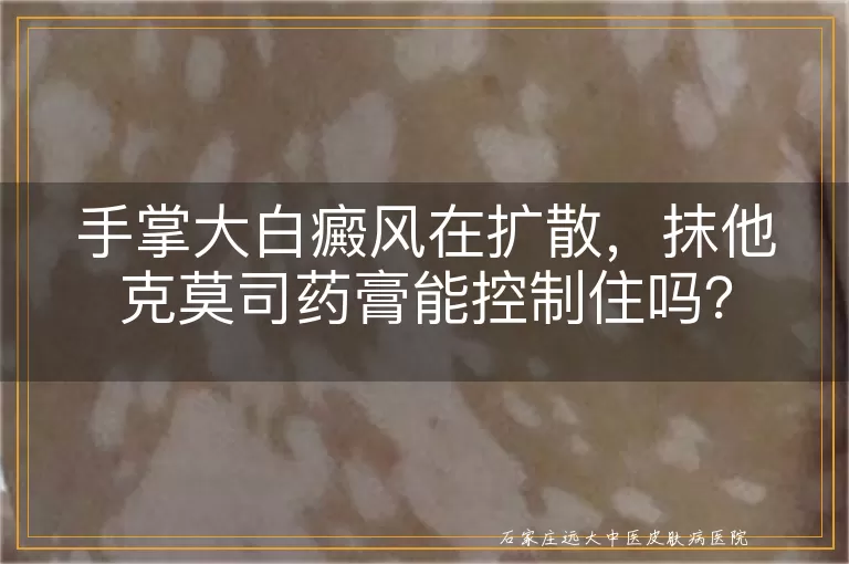 手掌大白癜风在扩散，抹他克莫司药膏能控制住吗？