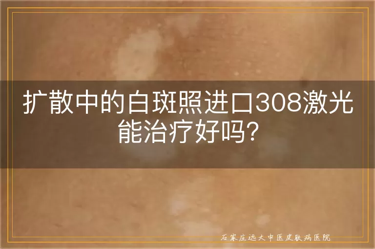 扩散中的白斑照进口308激光能治疗好吗？