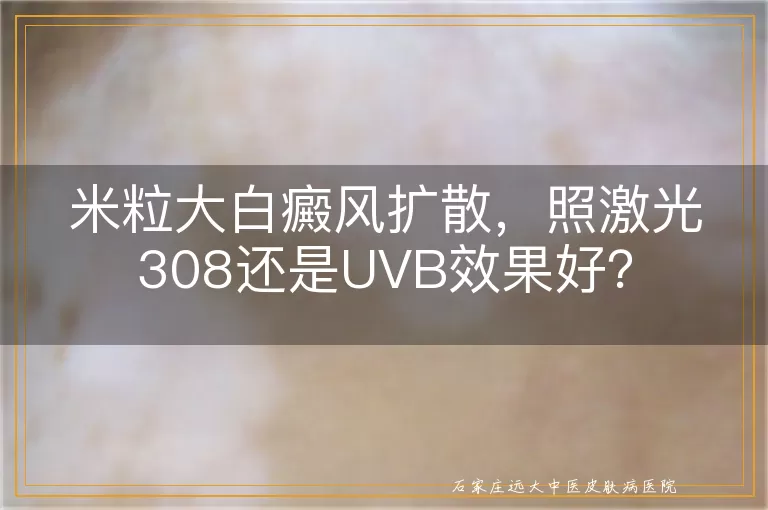 米粒大白癜风扩散，照激光308还是UVB效果好？