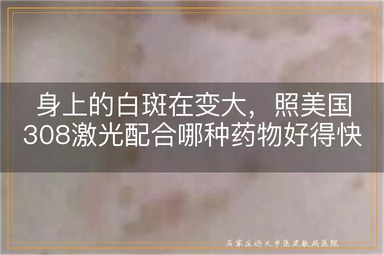 身上的白斑在变大，照美国308激光配合哪种药物好得快？