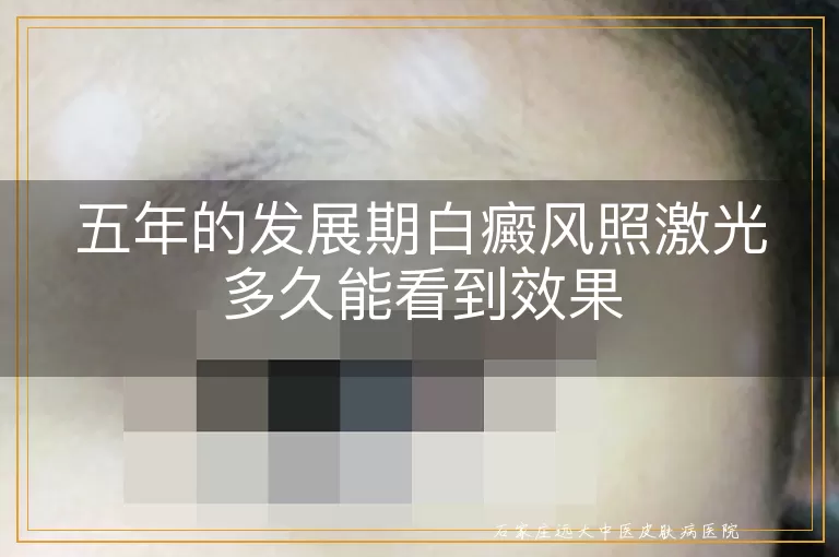 五年的发展期白癜风照激光多久能看到效果