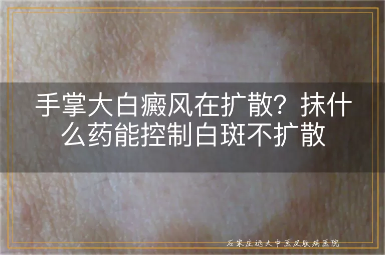 手掌大白癜风在扩散？抹什么药能控制白斑不扩散
