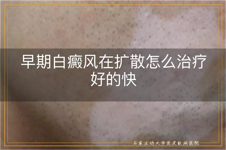 早期白癜风在扩散怎么治疗好的快