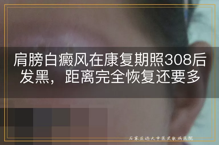 肩膀白癜风在康复期照308后发黑，距离完全恢复还要多久？
