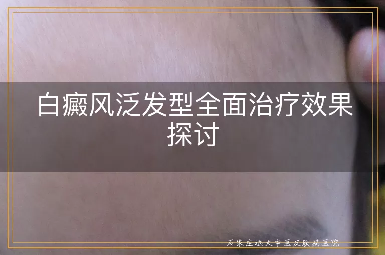 白癜风泛发型全面治疗效果探讨