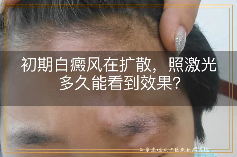 初期白癜风在扩散，照激光多久能看到效果？