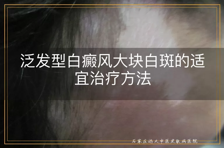 泛发型白癜风大块白斑的适宜治疗方法