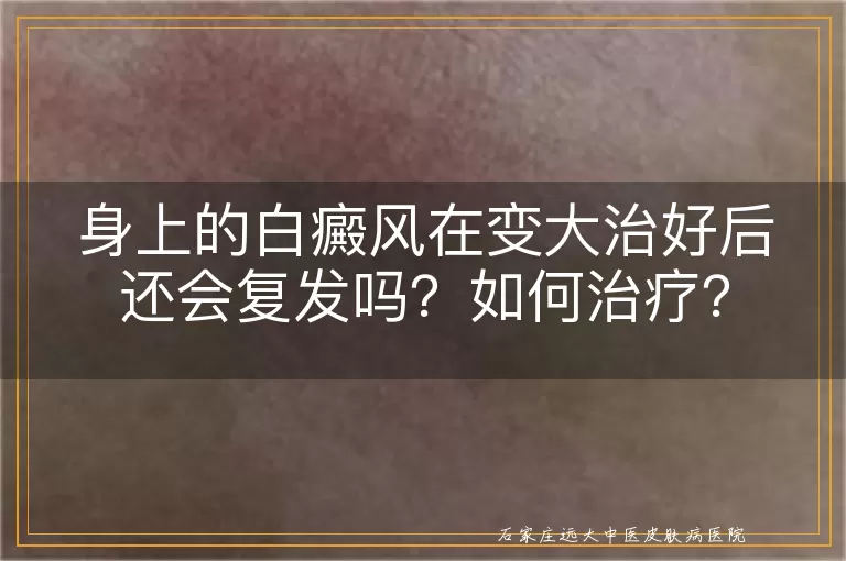 身上的白癜风在变大治好后还会复发吗?如何治疗?