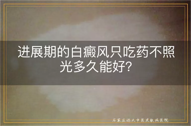 进展期的白癜风只吃药不照光多久能好？