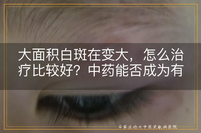 大面积白斑在变大，怎么治疗比较好？中药能否成为有效选择？