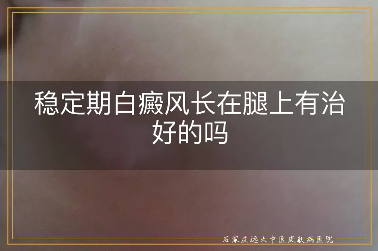 稳定期白癜风长在腿上有治好的吗
