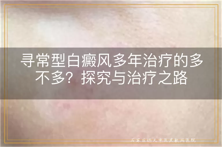 寻常型白癜风多年治疗的多不多？探究与治疗之路
