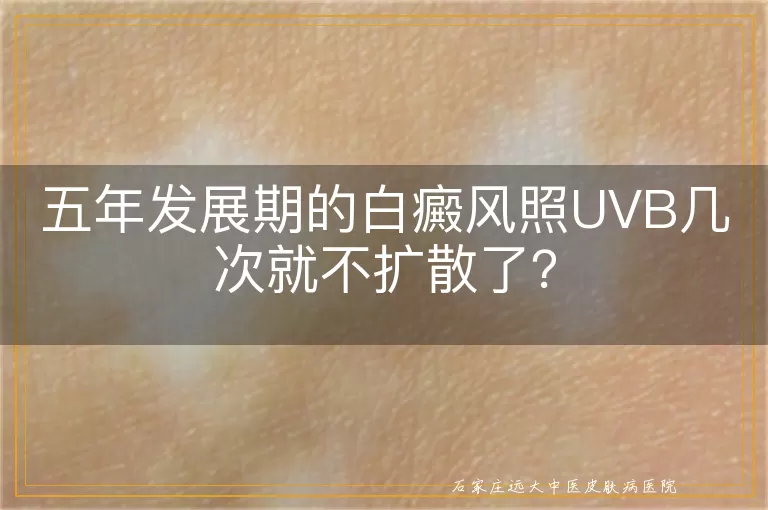 五年发展期的白癜风照UVB几次就不扩散了？