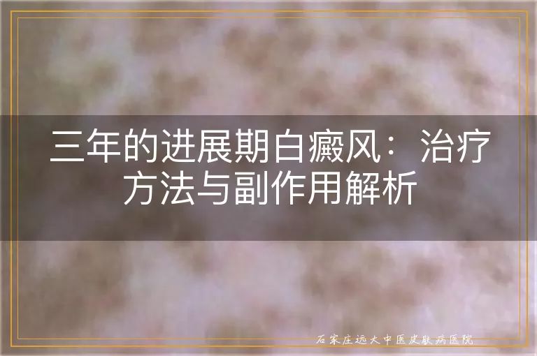三年的进展期白癜风：治疗方法与副作用解析