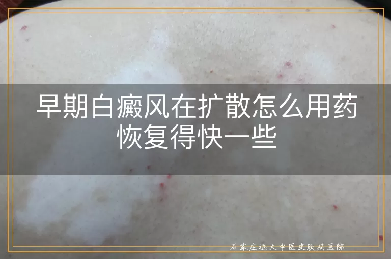 早期白癜风在扩散怎么用药恢复得快一些
