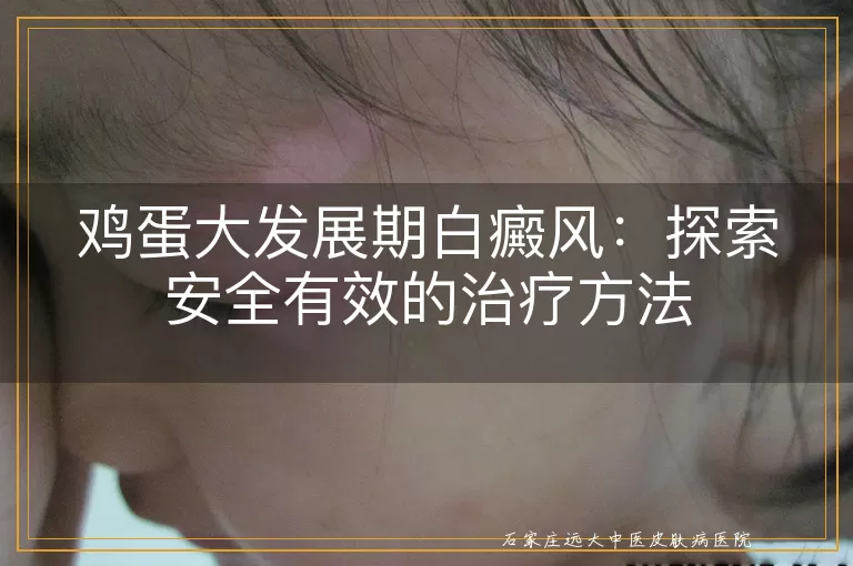 鸡蛋大发展期白癜风：探索安全有效的治疗方法
