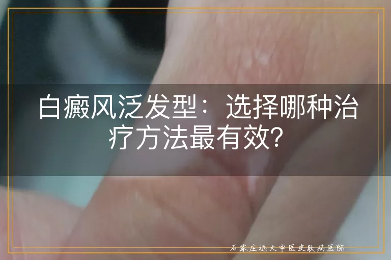 白癜风泛发型：选择哪种治疗方法最有效？