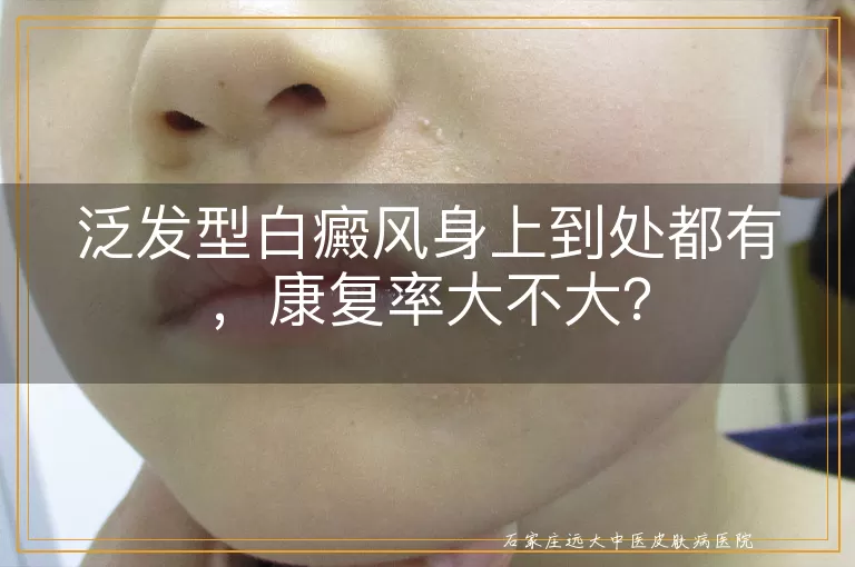 泛发型白癜风身上到处都有，康复率大不大？