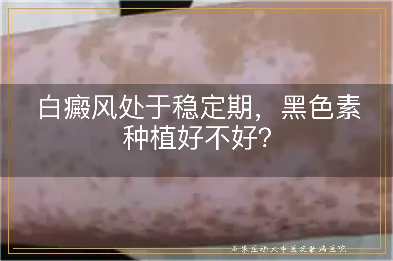 白癜风处于稳定期，黑色素种植好不好？