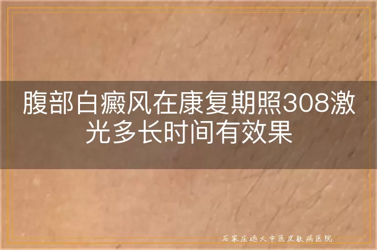 腹部白癜风在康复期照308激光多长时间有效果
