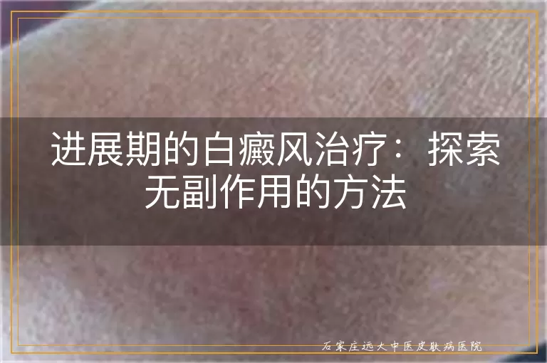 进展期的白癜风治疗：探索无副作用的方法