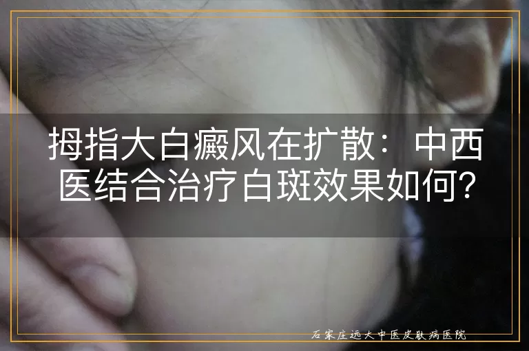拇指大白癜风在扩散：中西医结合治疗白斑效果如何？