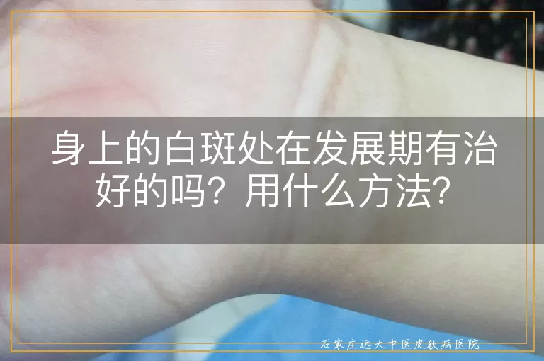 身上的白斑处在发展期有治好的吗？用什么方法？