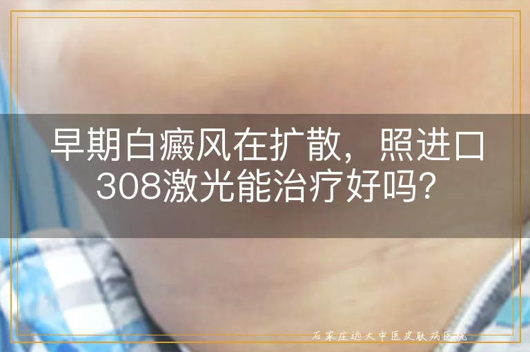 早期白癜风在扩散，照进口308激光能治疗好吗？