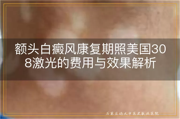 额头白癜风康复期照美国308激光的费用与效果解析