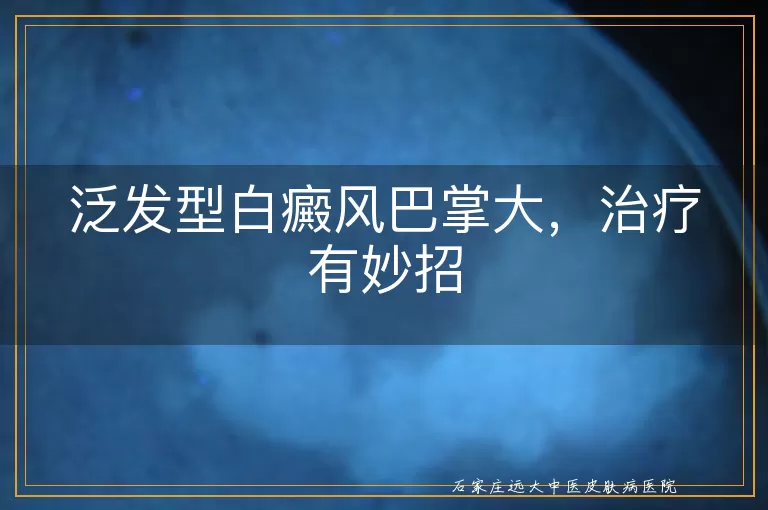 泛发型白癜风巴掌大，治疗有妙招