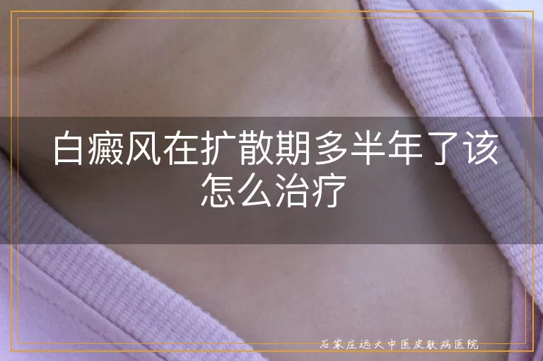 白癜风在扩散期多半年了该怎么治疗
