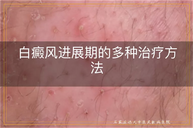 白癜风进展期的多种治疗方法