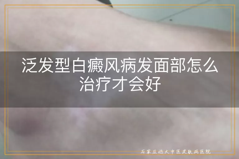 泛发型白癜风病发面部怎么治疗才会好