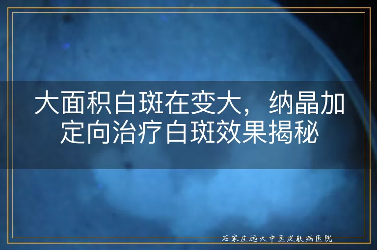 大面积白斑在变大，纳晶加定向治疗白斑效果揭秘