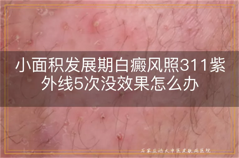 小面积发展期白癜风照311紫外线5次没效果怎么办