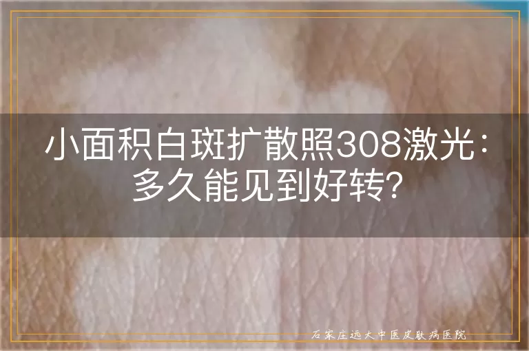 小面积白斑扩散照308激光：多久能见到好转？