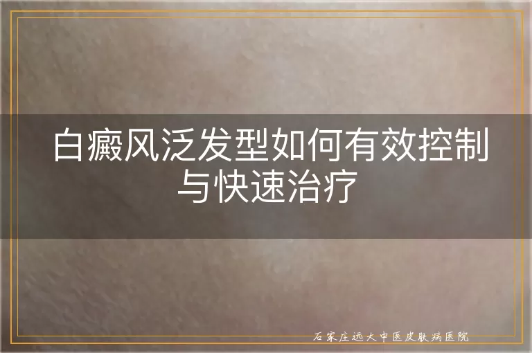 白癜风泛发型如何有效控制与快速治疗