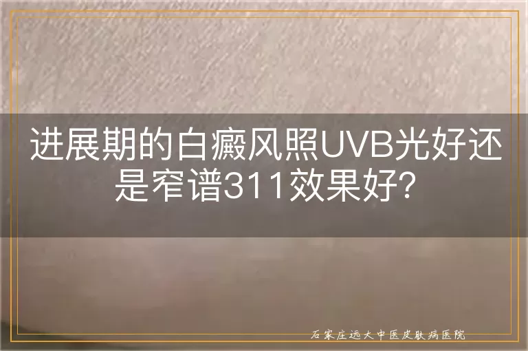 进展期的白癜风照UVB光好还是窄谱311效果好？