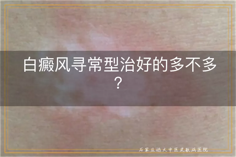 白癜风寻常型治好的多不多？