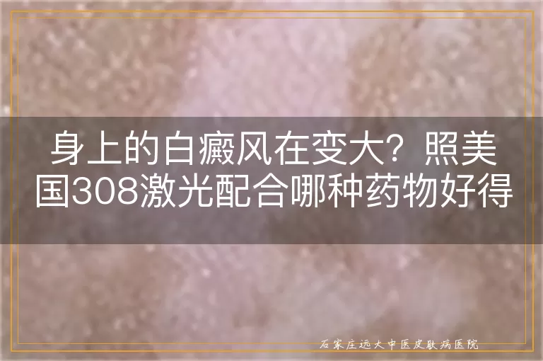 身上的白癜风在变大？照美国308激光配合哪种药物好得快
